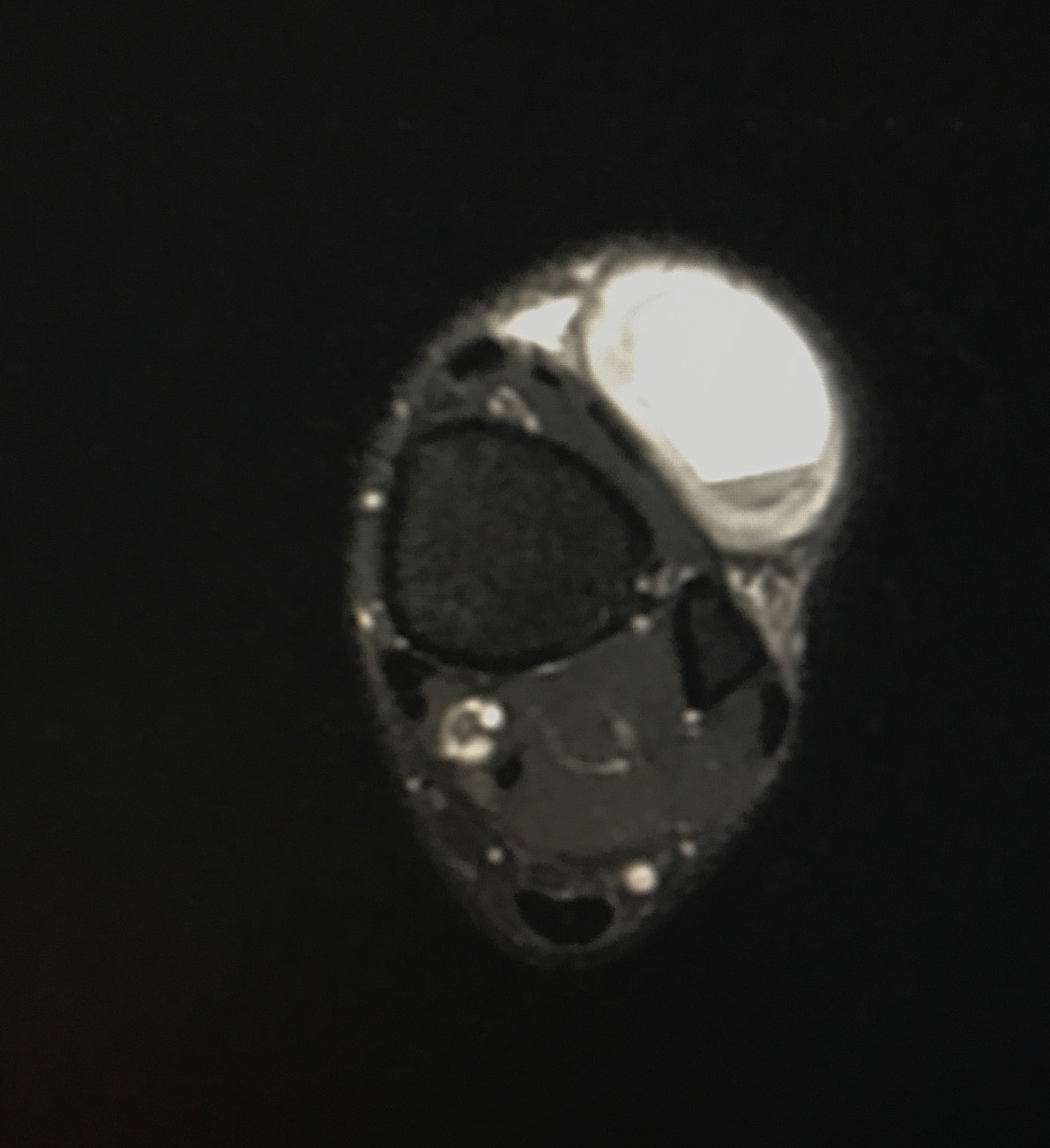 Figure 2 for case synovial sarcoma ( RID4558 ) of the ankle
